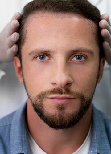 כמה יעלה לכם תהליך השתלת שיער?